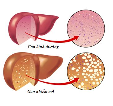 Gan nhiễm mỡ là bệnh lí khá phổ biến trong cuộc sống hiện đại.