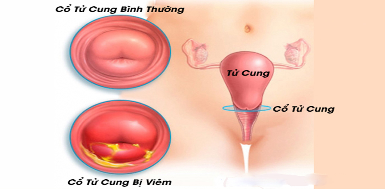 Viêm cổ tử cung mãn tính là gì?
