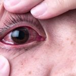 Cách điều trị bệnh đau mắt đỏ nguy hại đến sức khỏe thị lực