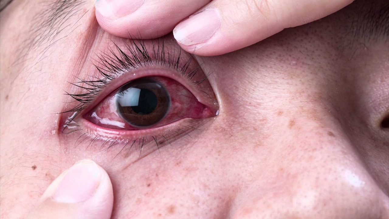 Viêm kết mạc dị ứng là gì và tại sao nó có thể gây ra đau mắt đỏ?
