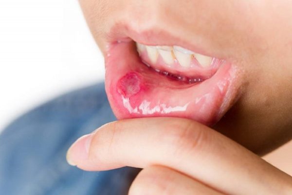 bệnh lở miệng khám ở đâu
