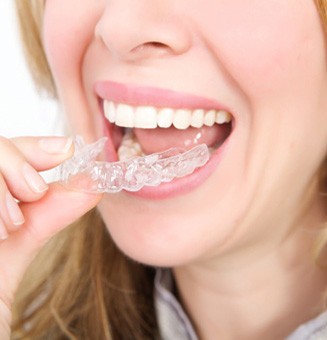 Niềng răng lợi và hại giảm thiểu nguy cơ gây bệnh răng miệng