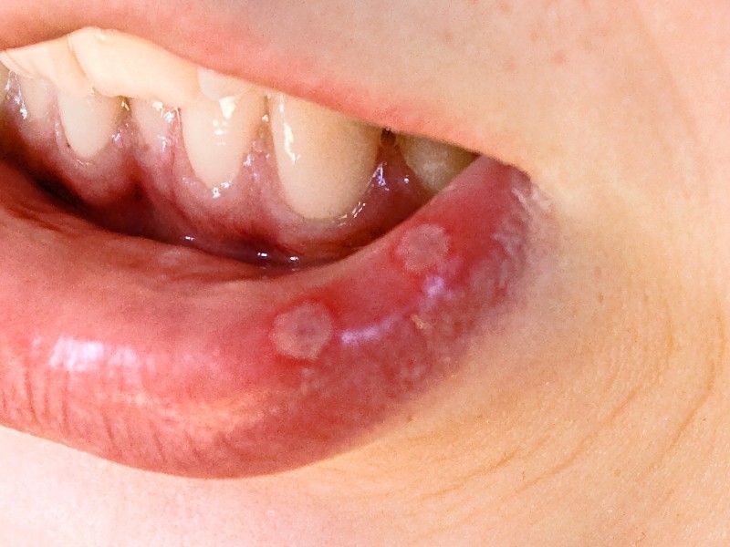 Rau xanh có tác dụng gì đối với nhiệt miệng ở bà bầu?
