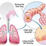 Bệnh phổi tắc nghẽn mạn tính là gì