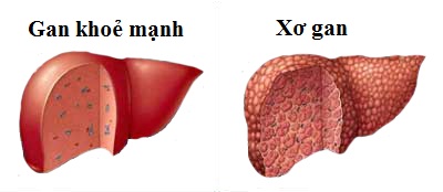 Tác động của xơ gan đến sức khỏe chung của người bệnh như thế nào?
