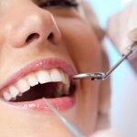 Giải đáp thắc mắc: Lấy cao răng có bị nhiễm HIV không?