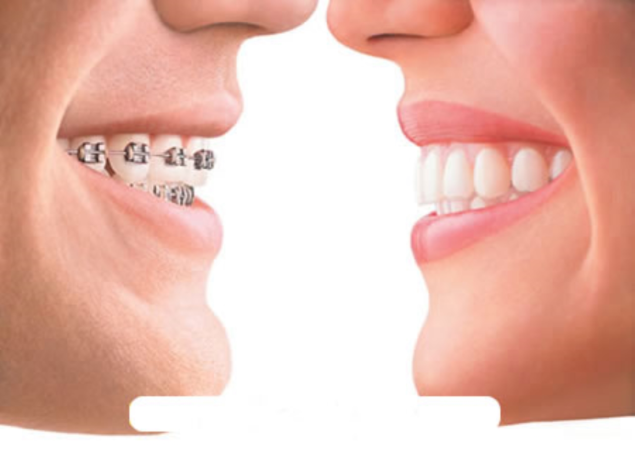 Ai là người phù hợp để niềng răng trong trường hợp răng quặp?
