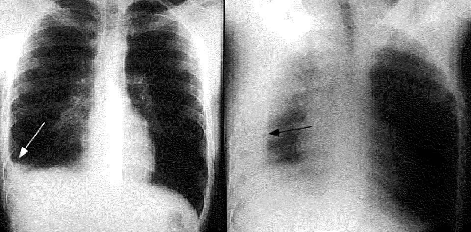 Vì sao bị tràn dịch màng phổi?