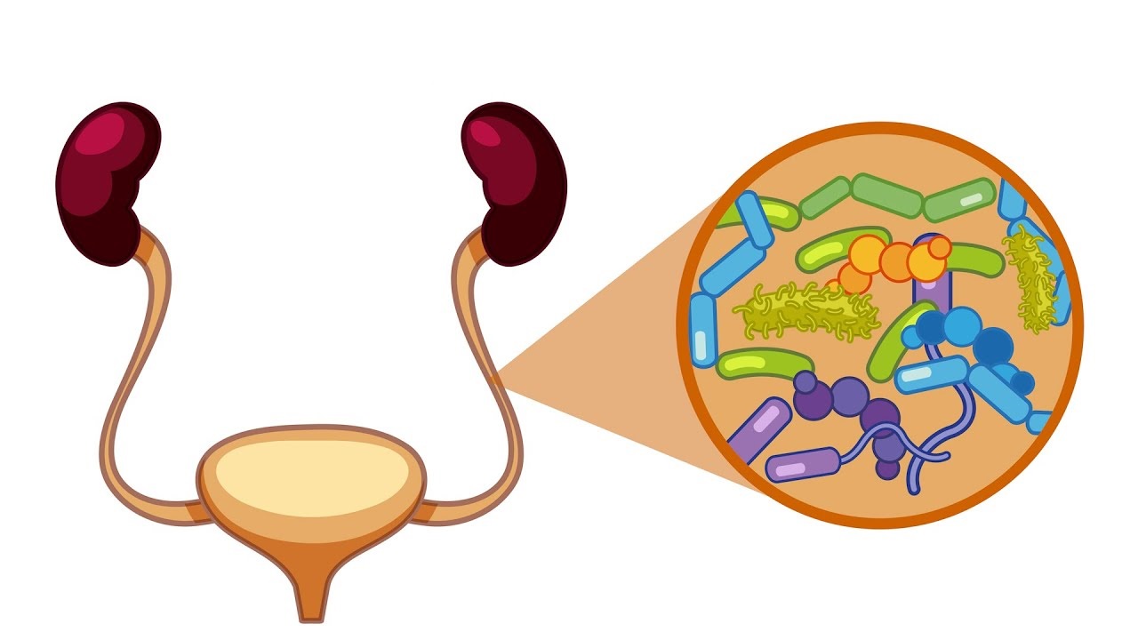 Vi khuẩn có vai trò gì trong viêm đường tiết niệu? 
