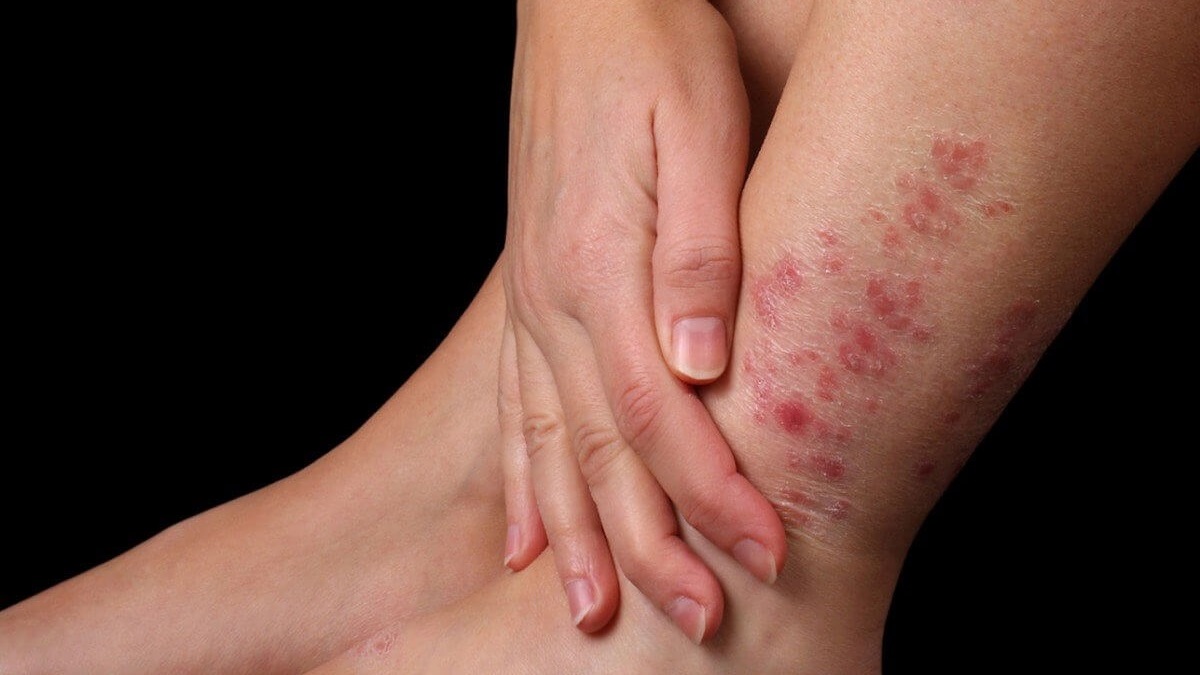 Dấu hiệu nhận biết khi bị nấm da có lây không và cách phòng ngừa