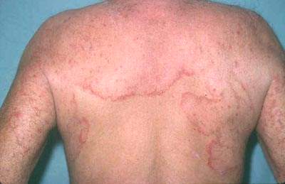 Cách phòng ngừa nhiễm nấm da để tránh nguy hiểm?
