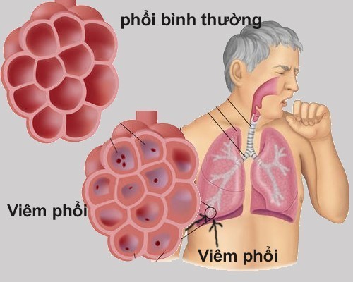 Vi khuẩn là nguyên nhân gây viêm phổi phổ biến nhất ở trẻ em và người lớn, đúng không?
