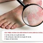 Bệnh nấm da bàn chân cần lưu ý điều gì khi điều trị