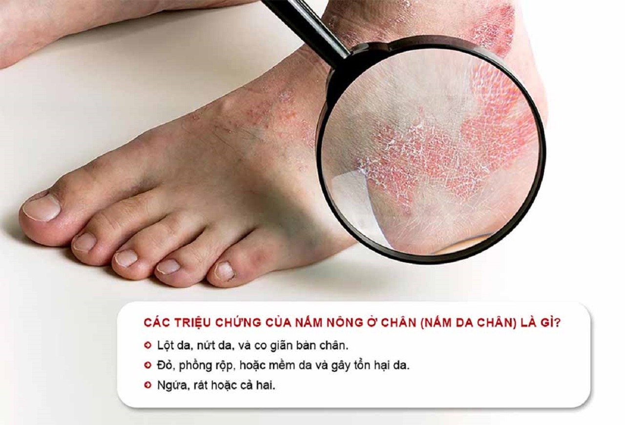 Tìm hiểu về bệnh nấm da bàn chân tại nhà hiệu quả