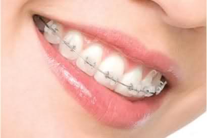 Niềng răng với mắc cài sứ đem lại tính thẩm mỹ cao hơn