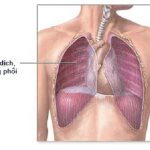 Tràn dịch màng phổi khoang màng phổi có dịch
