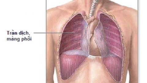 Tràn dịch màng phổi khoang màng phổi có dịch