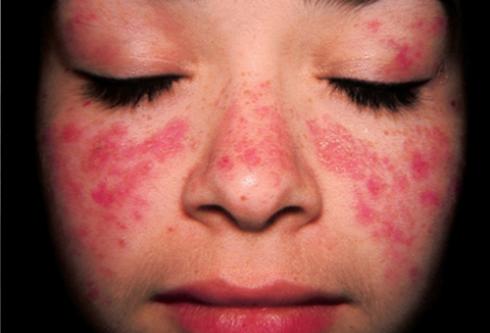 Bệnh lupus ban đỏ hệ thống và tác động của nó đến sức khỏe của phụ nữ?

