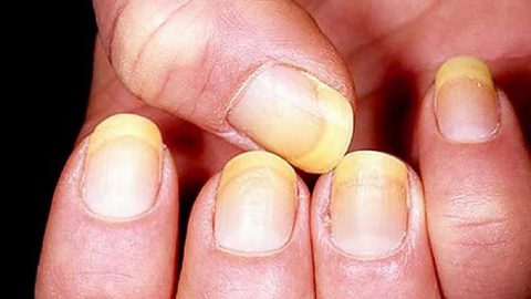 Dấu hiệu của bệnh nấm móng tay chúng ta chủ động trong điều trị