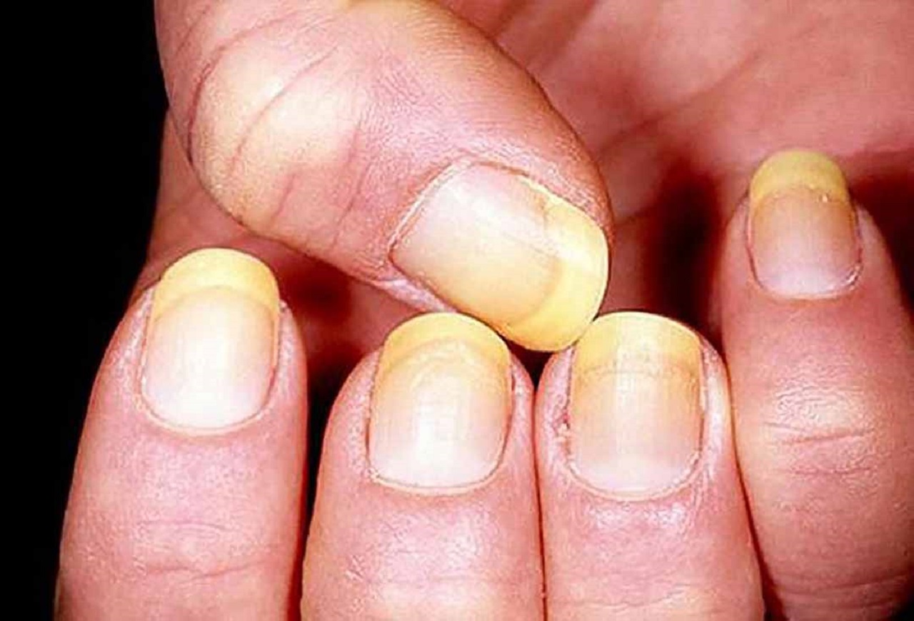 Dấu hiệu của bệnh nấm móng tay chúng ta chủ động trong điều trị