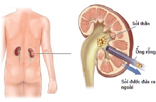 Phát hiện sớm những dấu hiệu của suy thận giúp nam giới chủ động trong việc phòng tránh và điều trị bệnh