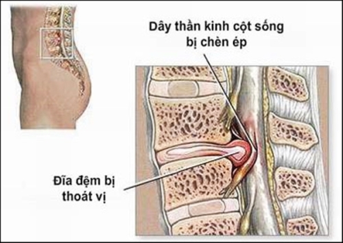 Thoát vị đĩa đệm là nguyên nhân chủ yếu gây đau thần kinh tọa