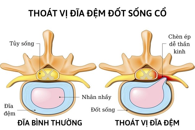 Đau Dây Thần Kinh Ở Cổ: Nguyên Nhân, Triệu Chứng và Cách Điều Trị Hiệu Quả