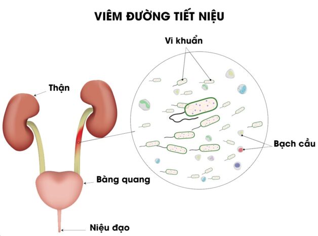 viem duong tiet nieu e1678784037532