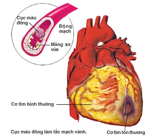 Dấu hiệu đau giữa ngực cần cảnh giác với bệnh mạch vành