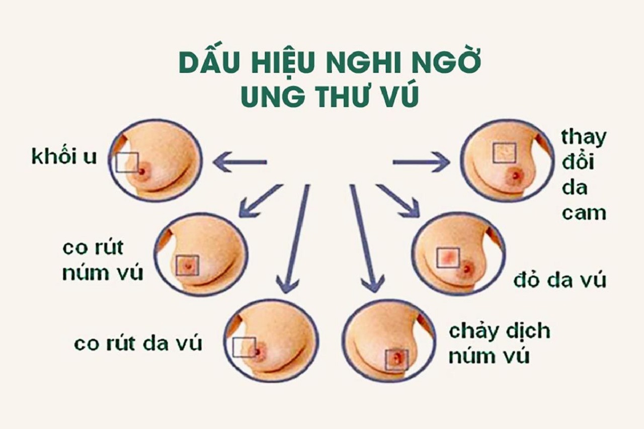 4. Phòng Ngừa Núm Vú Sần Sùi