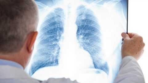 Bạn biết gì về tầm soát ung thư phổi