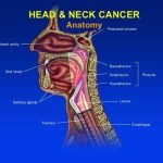Tìm hiểu bệnh ung thư đầu cổ phổ biến tại Việt Nam
