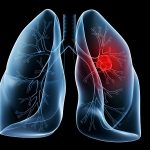 Ung thư phổi – bệnh ung thư nguy hiểm nhất thế giới