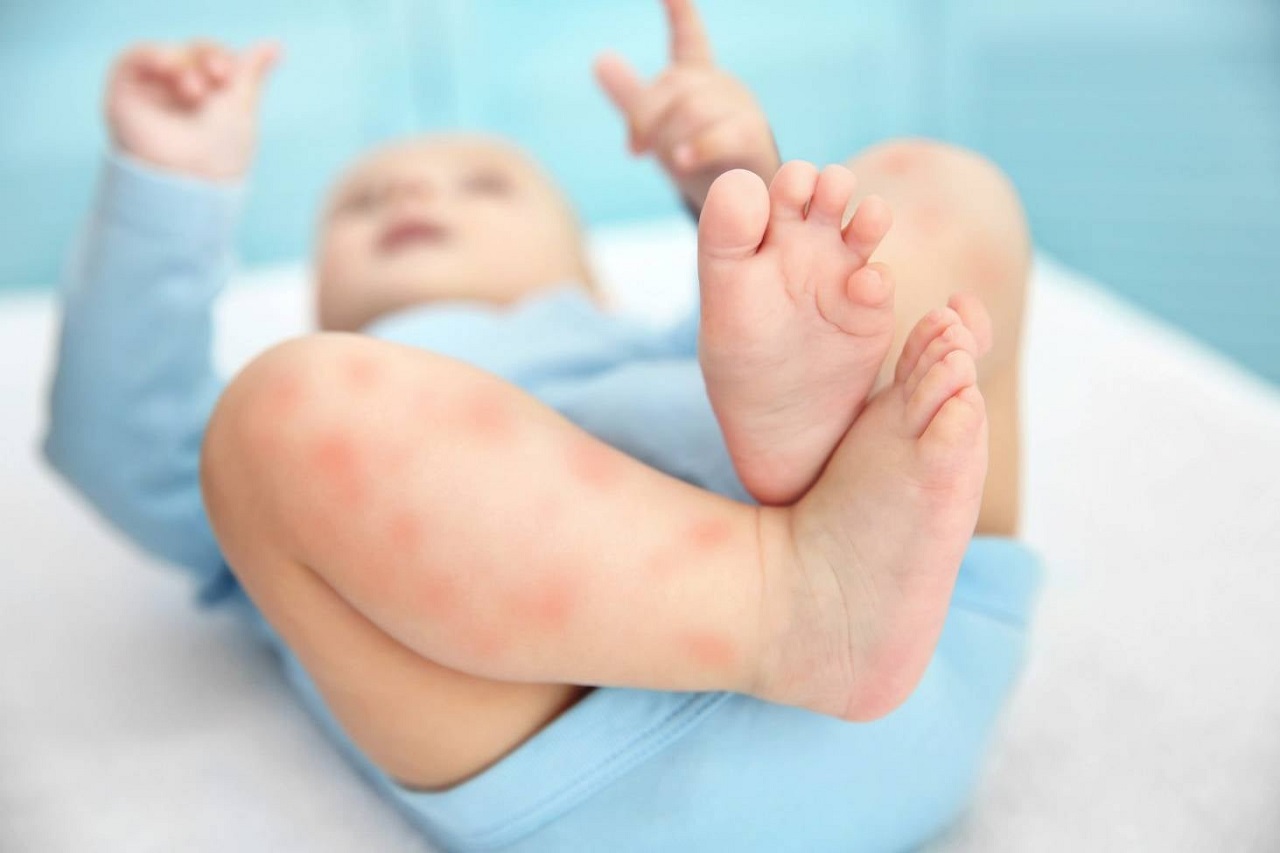 Cách phòng ngừa các bệnh da ở trẻ sơ sinh là gì?
