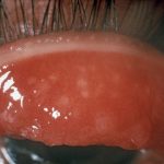 Những điều cần biết về bệnh đau mắt hột