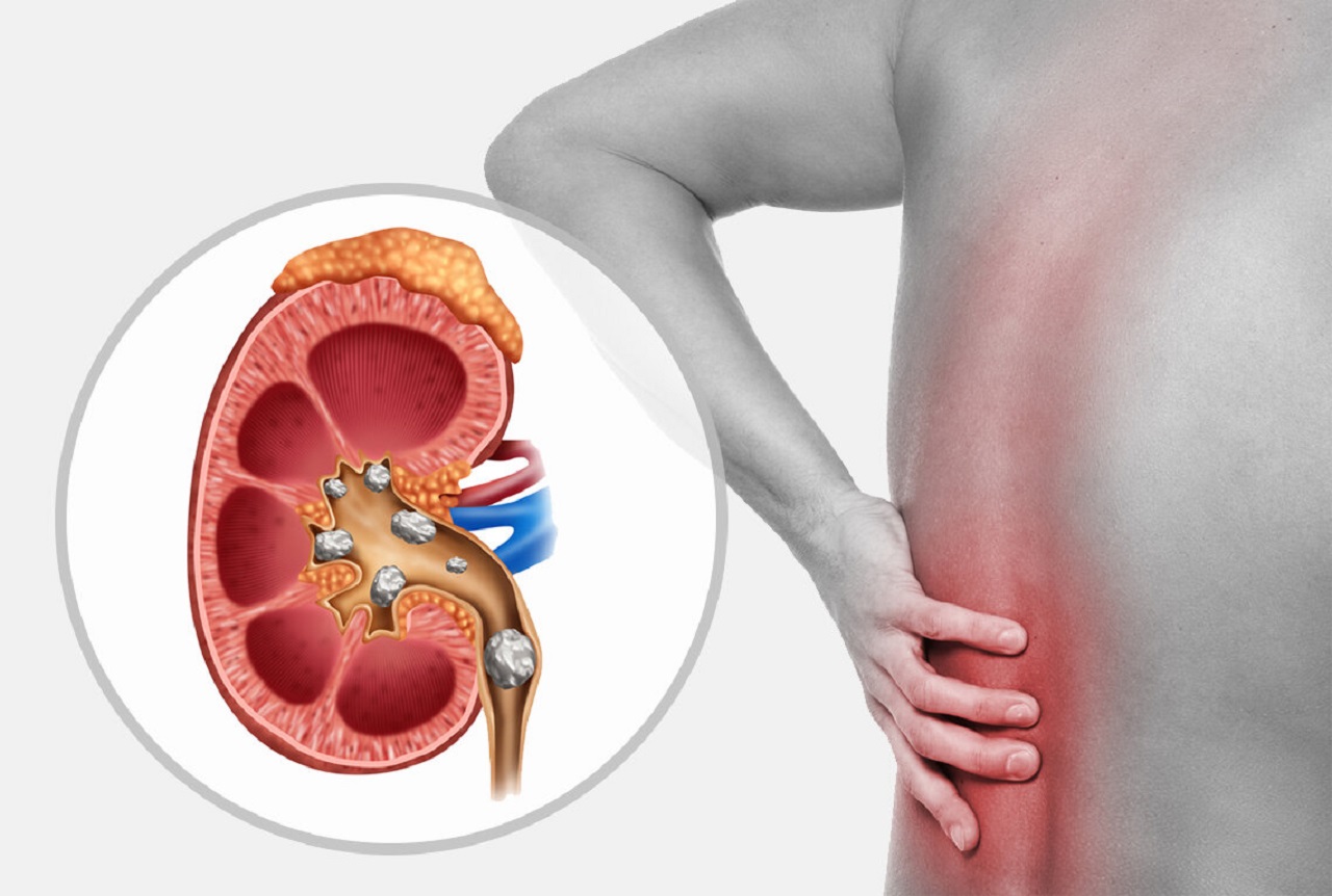 Có những loại sỏi thận nào có thể gây đau lưng?
