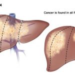 Ung thư gan giai đoạn cuối sống được bao lâu?