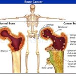 Tìm hiểu về bệnh ung thư xương