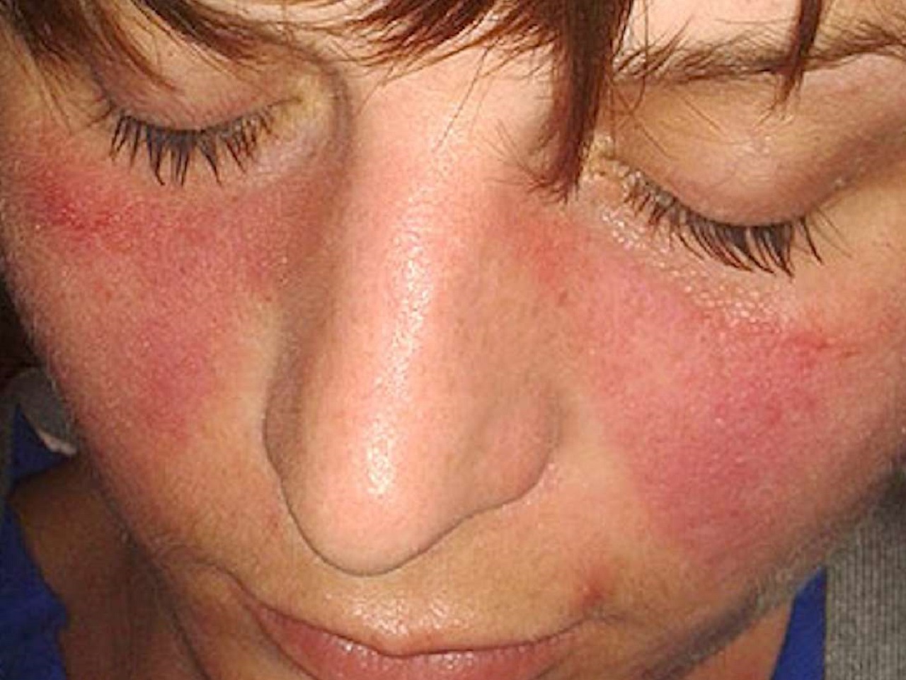 Bệnh lupus Chilblain có những dấu hiệu gì trên da và niêm mạc?

