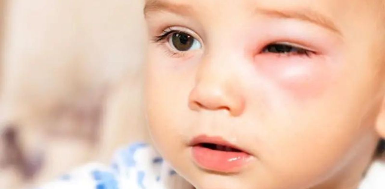 Thời gian điều trị bệnh đau mắt đỏ ở trẻ sơ sinh là bao lâu?
