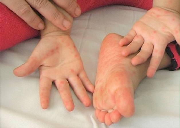 Một số bệnh nấm da ở trẻ nhỏ có khả năng lây lan
