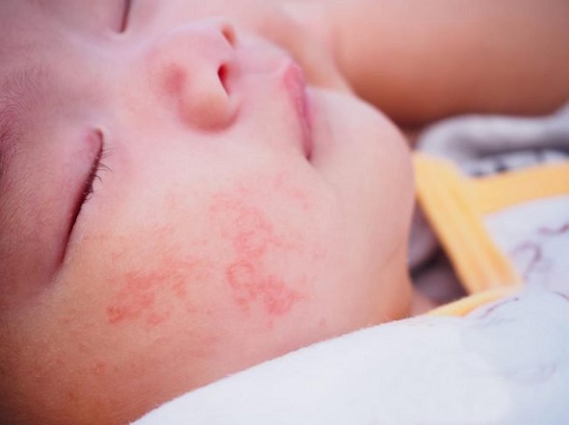 Nấm da mặt là một trong những bệnh nấm da ở trẻ thường gặp.