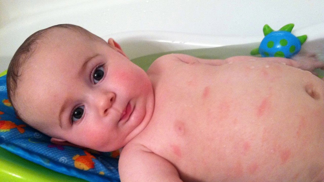 Các bệnh trẻ sơ sinh bị nấm da thường gặp và cách phòng tránh