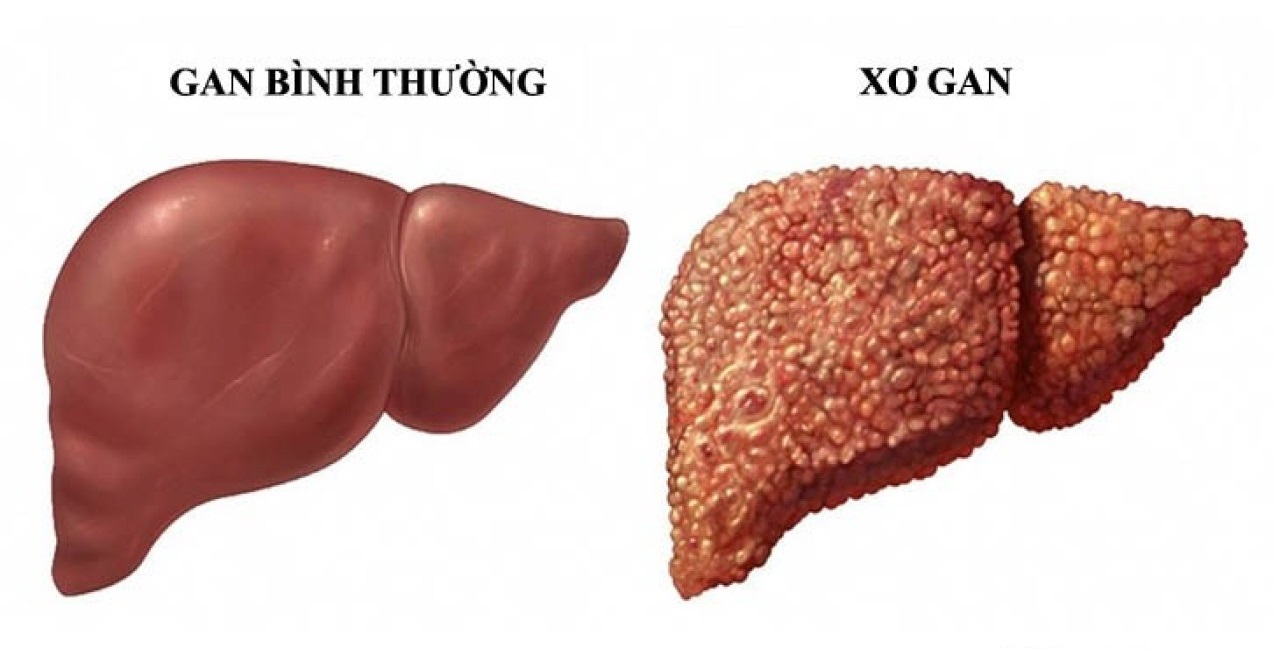 Xơ gan giảm tiểu cầu - Nhận biết, Điều trị và Những điều cần biết về căn bệnh nguy hiểm này