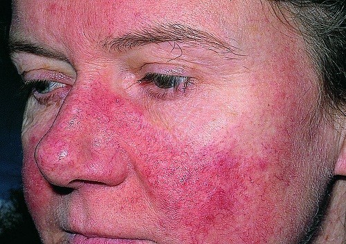 Cách phòng tránh bệnh lupus ban đỏ?
