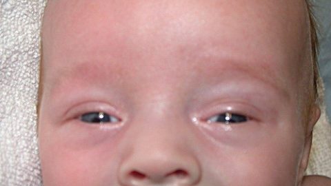Dấu hiệu bệnh đau mắt đỏ ở trẻ sơ sinh