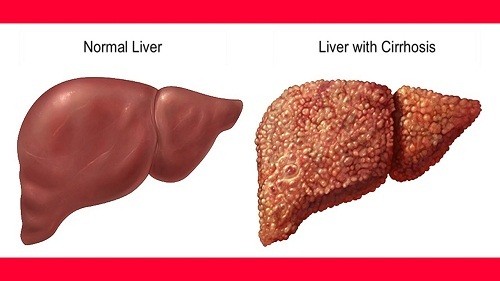 Xơ gan giai đoạn 4 biểu thị giai đoạn cuối của căn bệnh này.