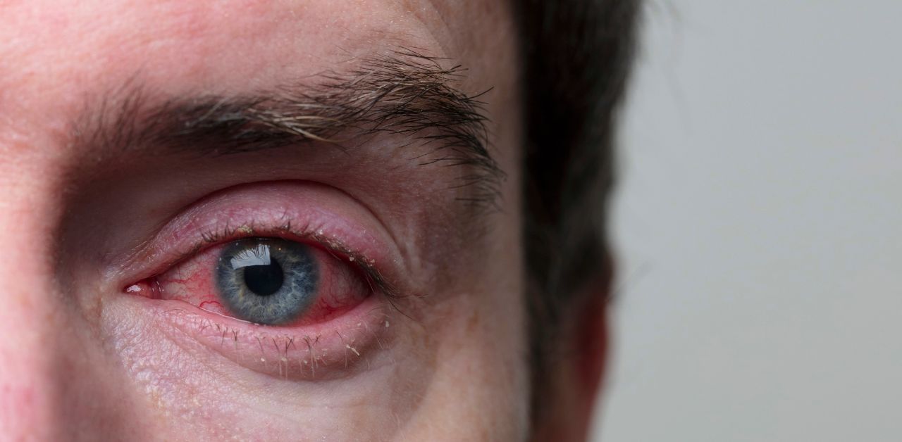 Viêm bờ mi mắt là căn bệnh gì và cách điều trị hiệu quả?
