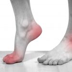 Dấu hiệu của bệnh gút ở bàn chân