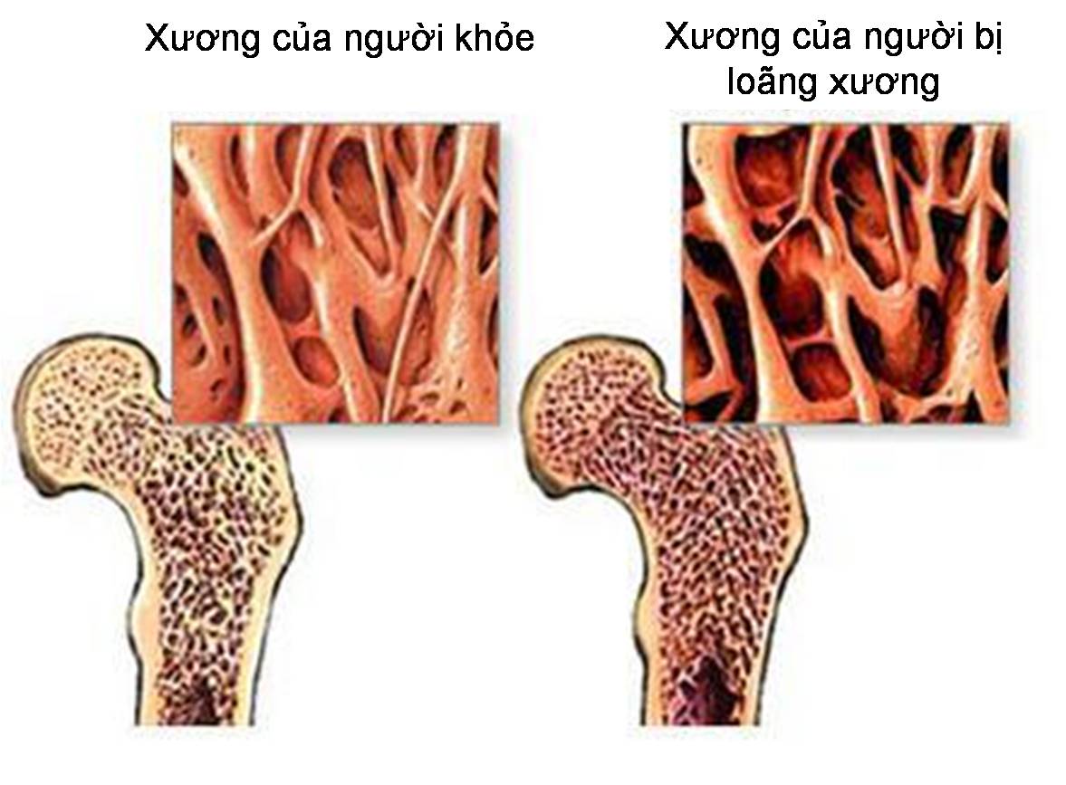 Bệnh xương khớp có di truyền sẽ ảnh hưởng đến cuộc sống hàng ngày của bệnh nhân như thế nào?
